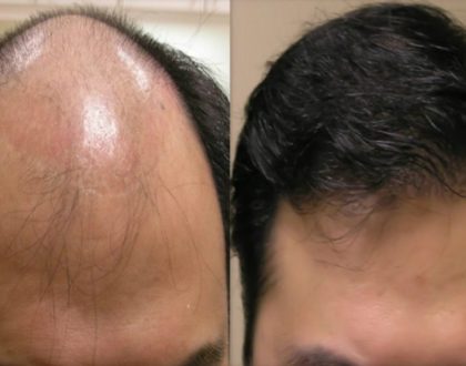 Hair Loss Tonic Malaysia