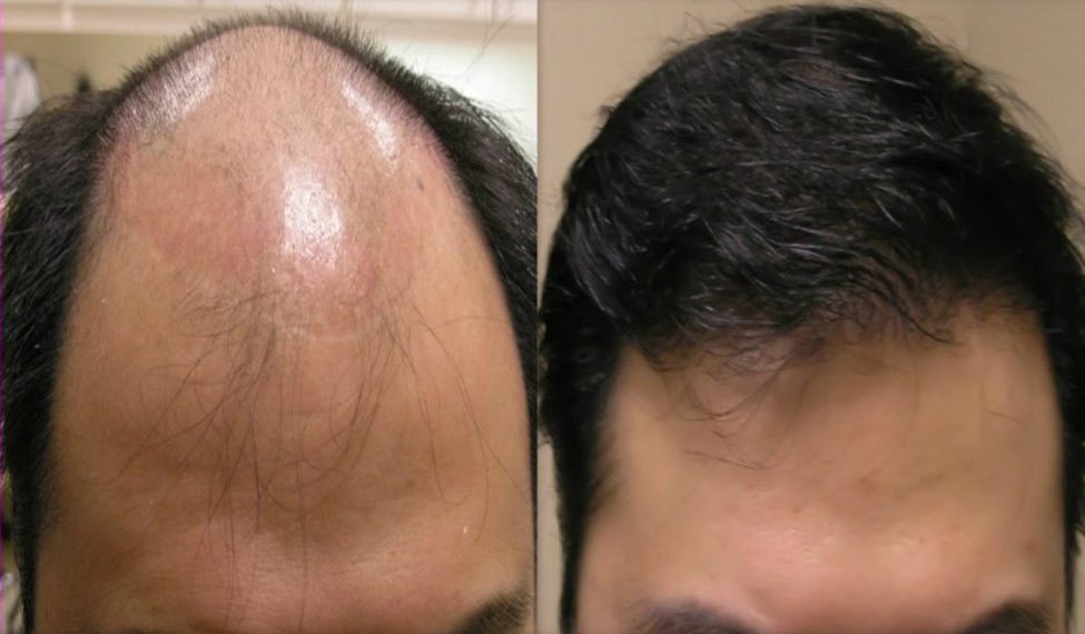 Hair Loss Tonic Malaysia